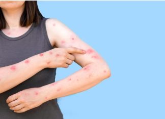 MPox: Sintomas, prevenção, tratamento e tudo que você deve saber sobre nova emergência global